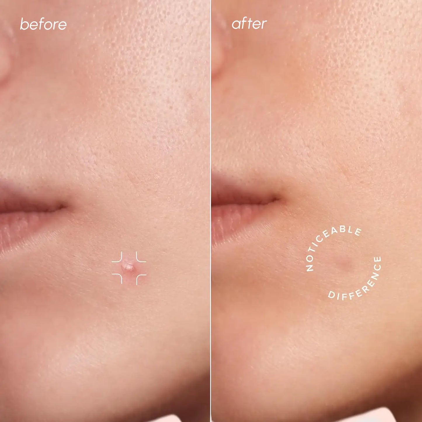 Invisible Pimple & Acne Patches Skin Care Maree